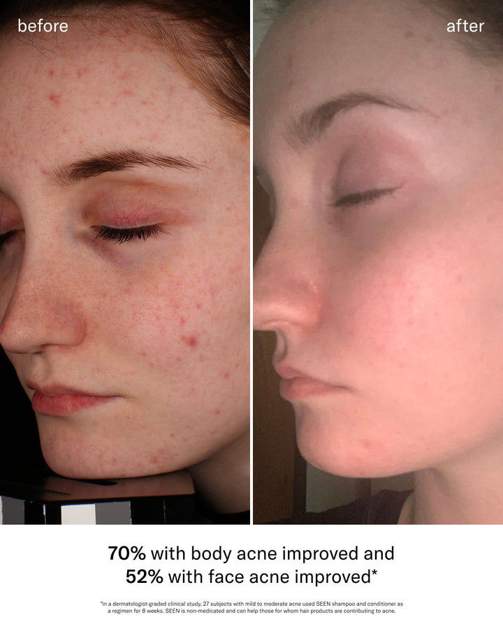 SEEN Acne-Safe Bundle