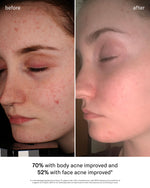 SEEN Acne-Safe Bundle, Fragrance Free